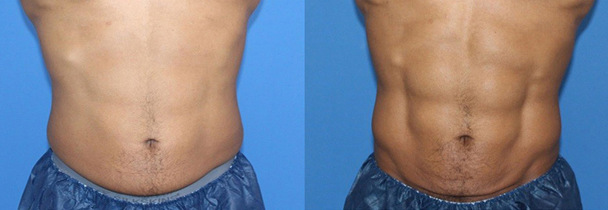 Durations : 12 weeks, Treatments : x4