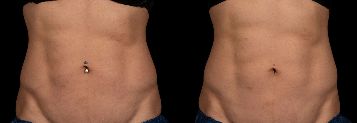 Durations : 8 weeks Treatments : x4